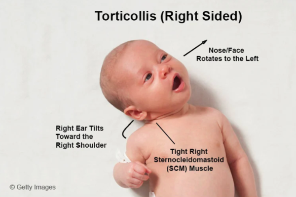 baby with torticollis